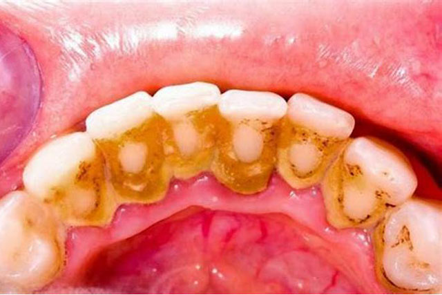 Mẹo làm sạch cao răng bằng mùi tây, hạt mè