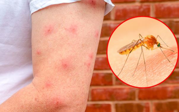 Vì sao có người sơ hở là bị muỗi đốt, người không đề phòng thì lại không bị phát nào?