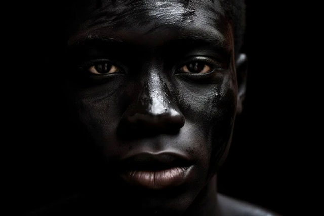 Tại sao đàn ông da đen có nguy cơ mắc ung thư tuyến tiền liệt cao hơn bình thường?