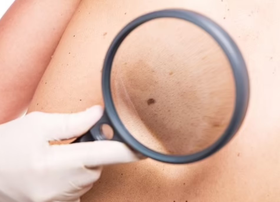 Công nghệ mới trên điện thoại 6G có thể giúp phát hiện sớm ung thư da