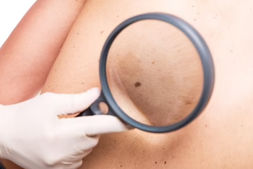 Công nghệ mới trên điện thoại 6G có thể giúp phát hiện sớm ung thư da