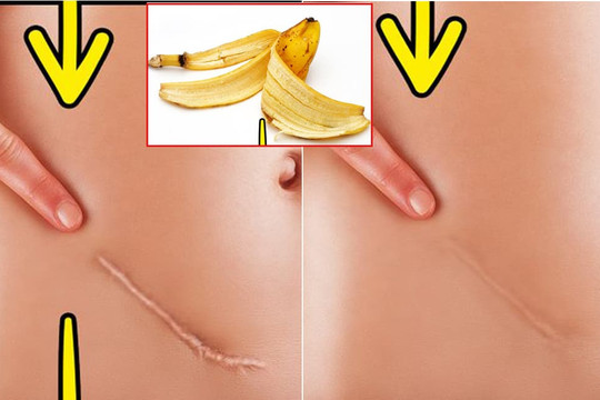 Vỏ chuối đừng vứt bỏ lãng phí, nó còn có 10 công dụng tuyệt vời này mà không nhiều người biết