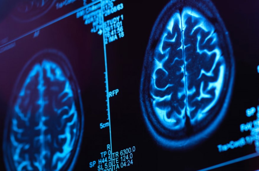 Ứng dụng mới giúp phát hiện sớm nguyên nhân gây mất trí nhớ