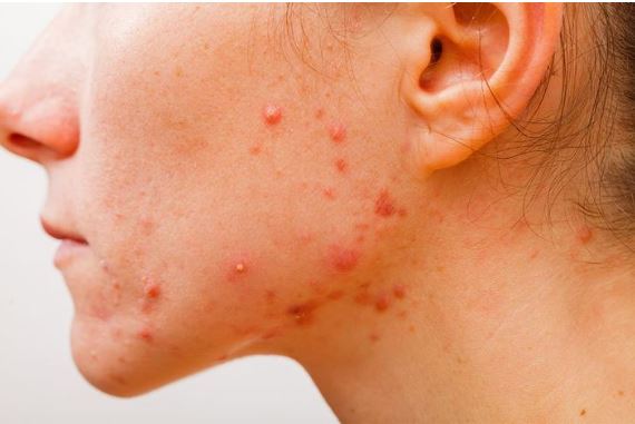 Tr&#x1ECB; m&#x1EE5;n &#x1EDF; c&#x1ED5; b&#x1EB1;ng tr&#xE0; xanh v&#xE0; b&#x1ED9;t ngh&#x1EC7;