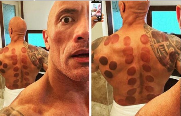 Liệu pháp chữa bệnh cổ xưa - giác hơi được 8 người nổi tiếng này dùng, bác sĩ nói gì?