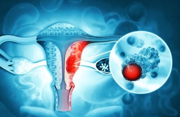 4 loại ung thư thường gặp ở phụ nữ và cách phát hiện sớm