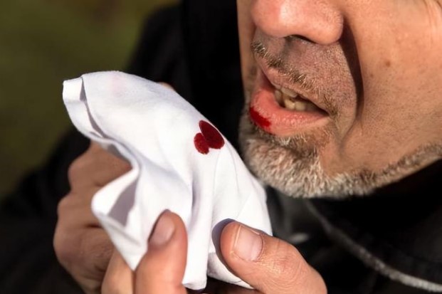 Nếu 4 hiện tượng này xuất hiện trong cơ thể, bạn hãy cảnh giác với khả năng mắc bệnh ung thư phổi