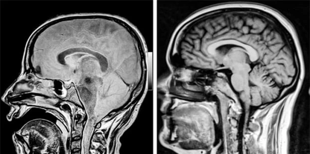   Bộ não của một người khi đang hôn mê và bộ não của người khỏe mạnh  