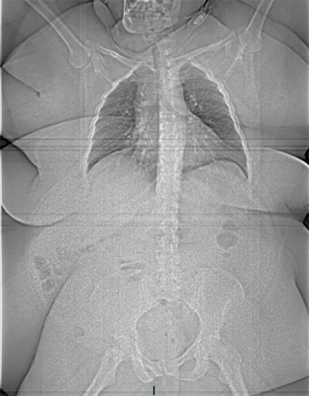   Ảnh chụp X-quang một bệnh nhân nặng 185 kg  