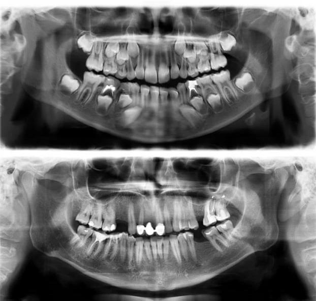   Hàm răng của một đứa trẻ 7 tuổi (trên) và hàm răng của một người 30 tuổi (dưới)  