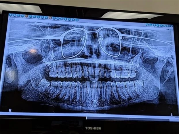   Ảnh chụp toàn cảnh hàm răng của một người đàn ông quên tháo kính mắt  