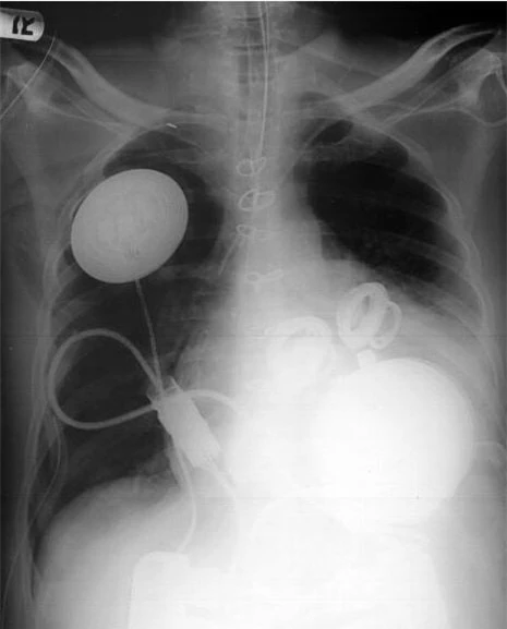   Trái tin nhân tạo (AbioCor Implantable Replacement Heart) của một bệnh nhân suy tim  