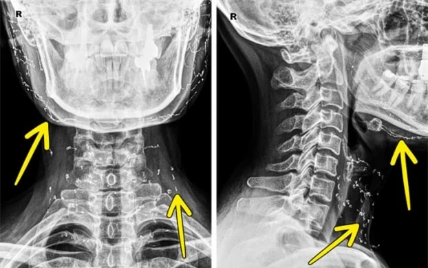   Ảnh chụp X-quang một bệnh nhân từng thực hiện nâng mặt bằng chỉ vàng  