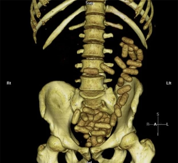   Ảnh chụp CT bụng một người bị bắt vì tội vận chuyển chất cấm trái phép  