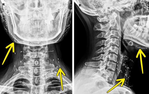 16 bức ảnh chụp X-quang tiết lộ những điều thú vị về cơ thể bạn hơn cả sách giáo khoa