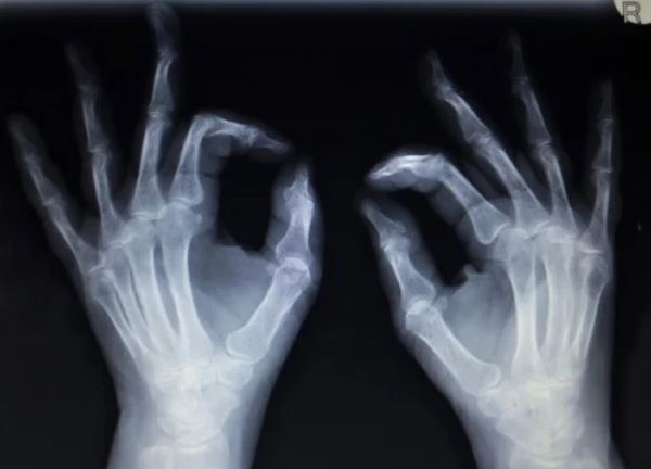 6 sự thay đổi ở cơ thể người cho thấy chúng ta vẫn đang tiến hóa