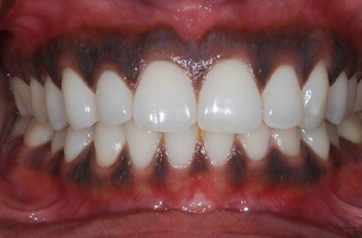 CLIP: Tại sao nướu của một số người lại có màu đen?