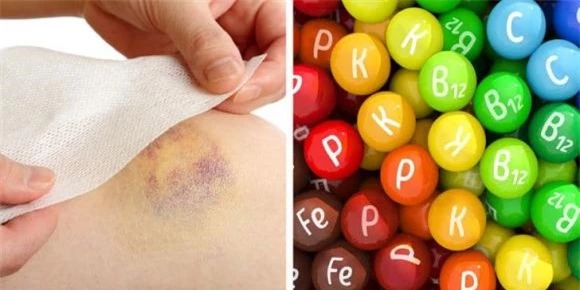 cơ thể tự nhiên bị bầm tím 0 bầm tím, vết bầm tím, sức khỏe