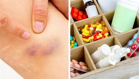 cơ thể tự nhiên bị bầm tím 6 bầm tím, vết bầm tím, sức khỏe