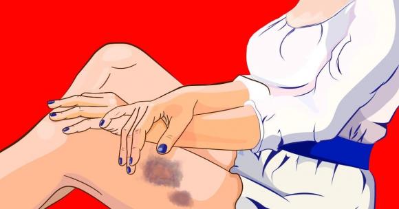 Nếu bạn có những vết bầm tím không thể giải thích được trên cơ thể, thì đây là 7 vấn đề sức khỏe có thể phải đối mặt