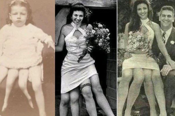 Điều ít biết về cô gái có 4 chân từng nổi tiếng như minh tinh: Là niềm mơ ước của bao chàng trai, lấy chồng sinh 5 con, đem bản thân làm triển lãm