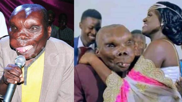 Người đàn ông xấu xí nhất trên thế giới! Mới 10 tuổi mắc chứng bệnh lạ “siêu xấu xí” nhưng anh lại nổi tiếng chỉ qua một đêm và cưới 3 vợ