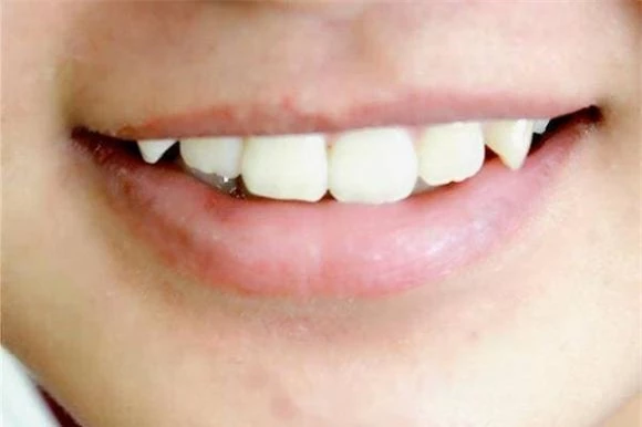 làm sạch răng, làm sạch răng đúng cách, mảng bám vàng trên răng