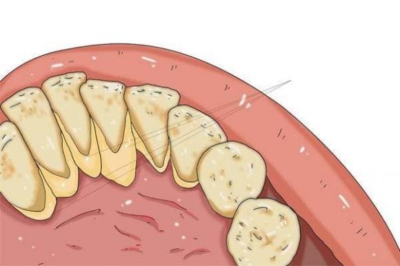 Mảng bám vàng trên răng, xấu xí và nặng mùi! Ba cách để giúp răng của bạn trắng hơn