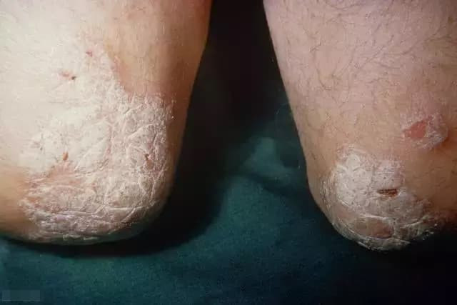 Làm gì nếu bạn bị bệnh vẩy nến? Đừng hoảng sợ, 4 phương pháp điều trị có thể giúp bạn thuyên giảm tình trạng bệnh