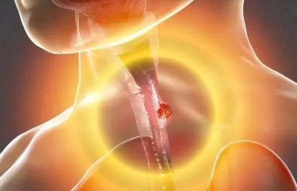 T&#x1B0;&#x1EDF;ng vi&#xEA;m h&#x1ECD;ng m&#xE3;n t&#xED;nh, &#x111;i kh&#xE1;m v&#xE0; &#x111;&#x1B0;&#x1EE3;c ph&#xE1;t hi&#x1EC7;n m&#x1EAF;c ung th&#x1B0; th&#x1EF1;c qu&#x1EA3;n? B&#xE1;c s&#x129;: 5 &#x111;i&#x1EC3;m kh&#xE1;c bi&#x1EC7;t c&#x1EA7;n hi&#x1EC3;u