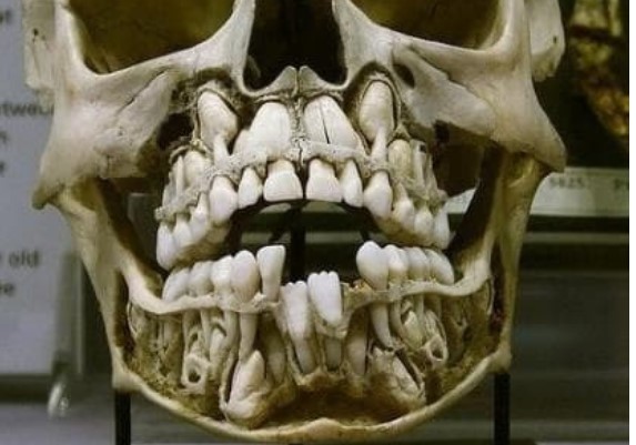 Hóa ra khi thay răng chúng ta đã đáng sợ đến vậy! Mọi người đều đã trải qua!