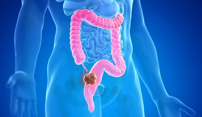 Kết quả thử nghiệm tích cực của thuốc giúp 'tan chảy' khối u ung thư