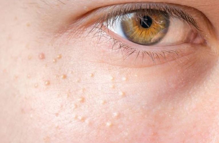 4 dấu hiệu trên làn da cảnh báo chỉ số cholesterol cao