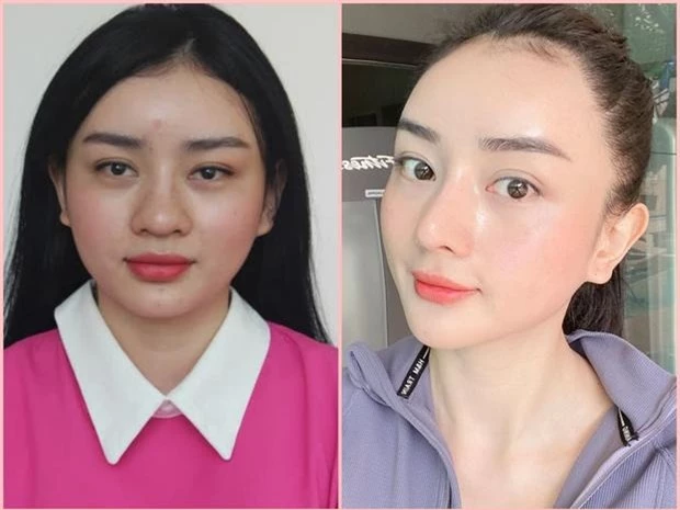 Angela Chu trước và sau khi phẫu thuật