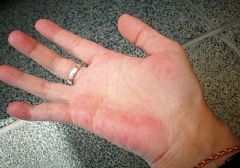 “2 ngứa, 2 đỏ, 2 đau” cho thấy gan kiệt sức vì bệnh tật, không thể tự tái tạo