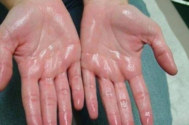 Trời nóng dễ đổ mồ hôi nhưng bác sĩ nhắc nhở 7 kiểu này là bệnh, gồm cả ung thư