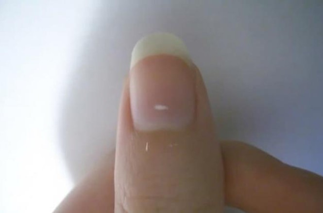 Chấm trắng trên móng tay không hẳn chỉ là thiếu khoáng chất, có thể là báo hiệu của những căn bệnh nguy hiểm