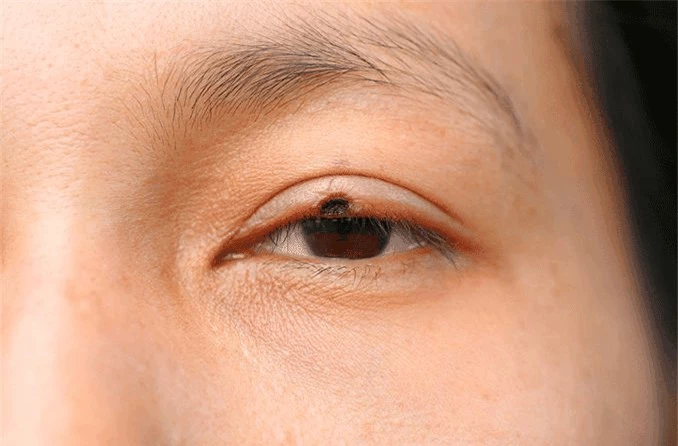 Nổi u trên mí mắt: Dấu hiệu ung thư hay bệnh lý khác?- Ảnh 1.