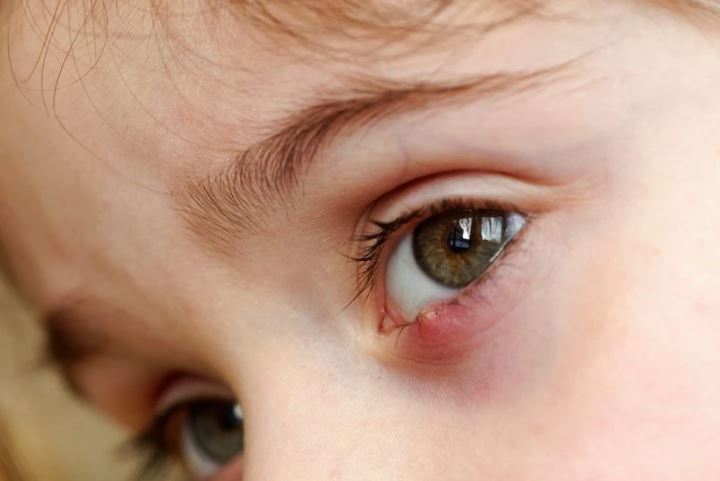 Nổi u trên mí mắt: Dấu hiệu ung thư hay bệnh lý khác?