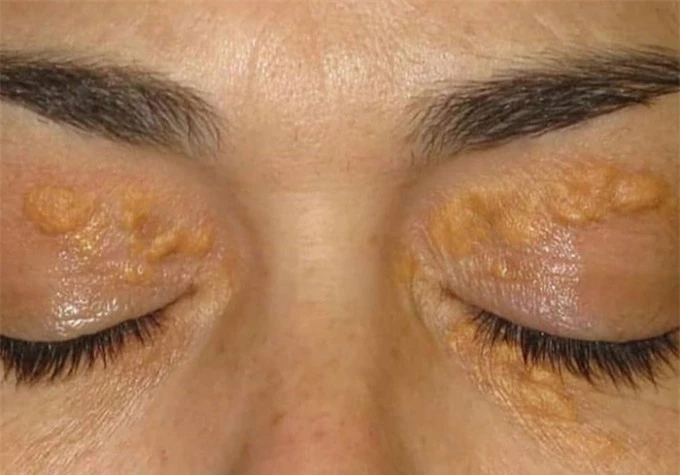   Các ban vàng, u vàng mí mắt thường do tích tụ mỡ máu và có liên quan tới bệnh tim mạch (Ảnh minh họa)  