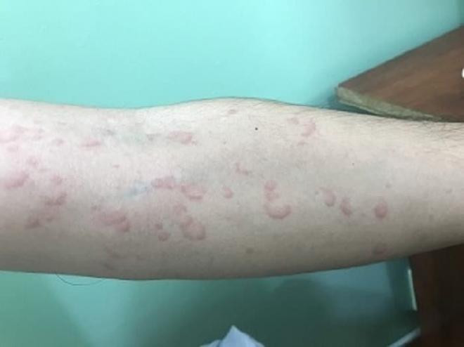 Làm thế nào để hết ngứa mề đay trong mùa hè? Phòng ngừa và điều trị nên được thực hiện trong ba bước, bạn đã hiểu chưa?