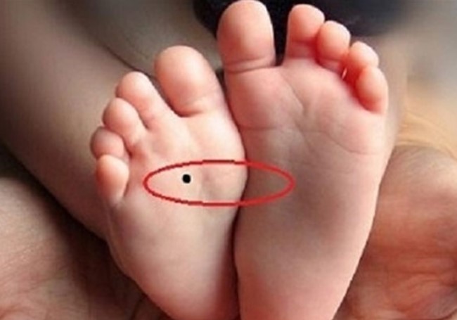 Có phải nốt ruồi ở lòng bàn là phúc tướng, tiền tiêu khỏi nghĩ?