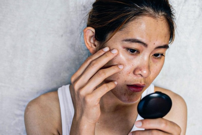 Lạm dụng kem chống nắng, cô gái bị loãng xương đến độ không nhai nổi