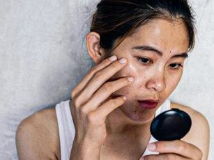 Lạm dụng kem chống nắng, cô gái bị loãng xương đến độ không nhai nổi