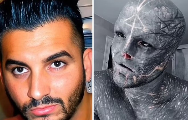 Người đàn ông 35 tuổi biến thành ‘dị nhân’, trải qua hàng chục cuộc phẫu thuật: cắt mũi, cắt tai và 2 ngón tay