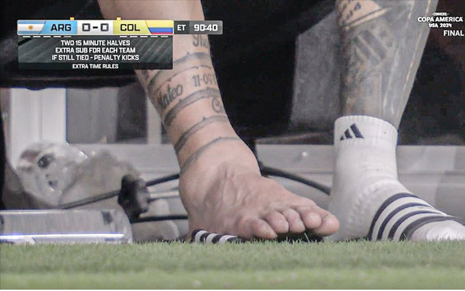 Chân của Messi biến dạng