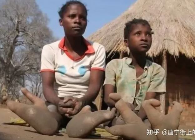 Bí ẩn về bộ tộc "đà điểu": Không thể đi giày vì thiếu ngón chân!