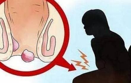 'Mười người đàn bà, chín người trĩ', phụ nữ nên tránh xa các bệnh về hậu môn trực tràng như thế nào?
