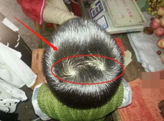 Trẻ có hơn “2 vòng xoáy” trên đầu có nghĩa là gì? Có liên quan đến chỉ số IQ không?
