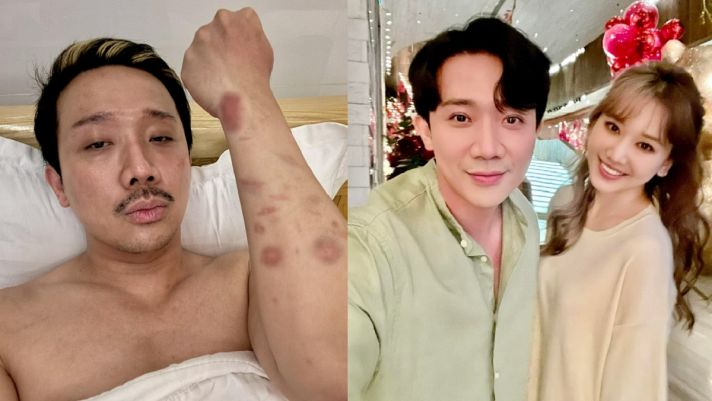 Trấn Thành lộ cánh tay bầm dập thấy thương, lập tức bị bà xã Hari Won 'trách yêu'